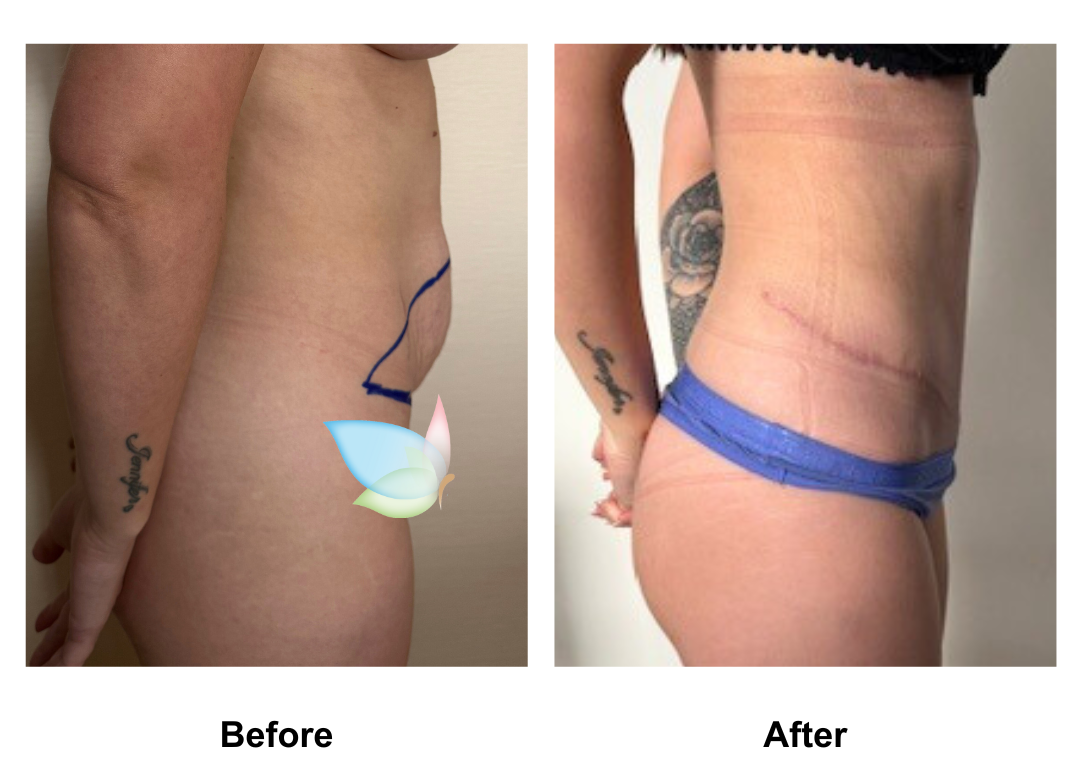 Tiana had Ex TT with Dr. Angkana