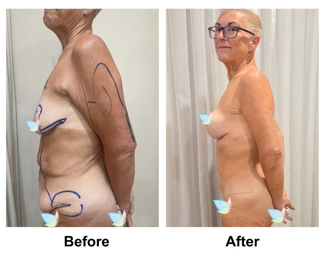 Tina had BABL (225HP) + ExTT + Mons lift + VASER 3 areas +  AL with Dr. Kasemsak (2)
