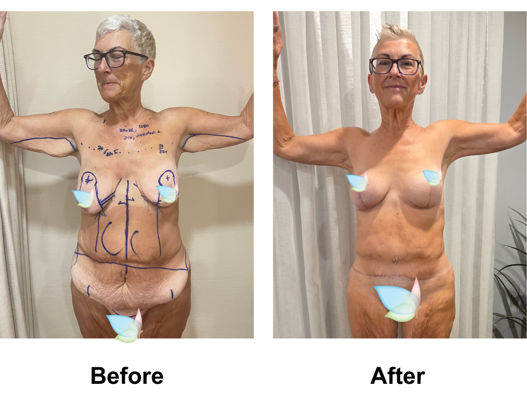 Tina had BABL (225HP) + ExTT + Mons lift + VASER 3 areas +  AL with Dr. Kasemsak (3)