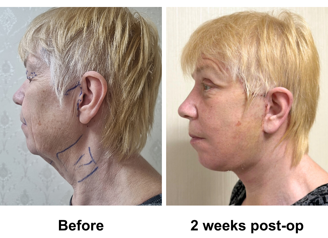 Tina had FFNL + Chin lift + UB + LB with Dr. Ring (2)
