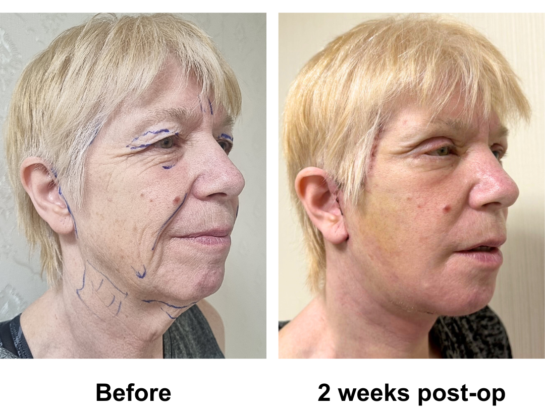 Tina had FFNL + Chin lift + UB + LB with Dr. Ring (3)