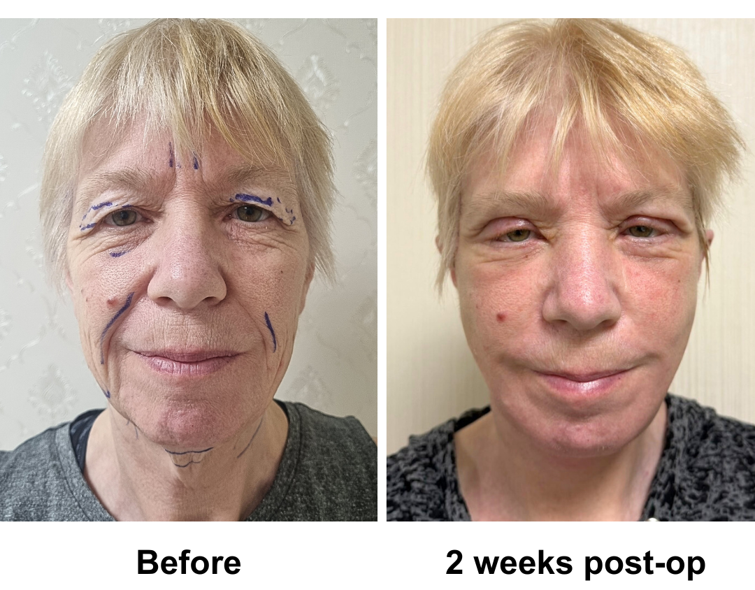 Tina had FFNL + Chin lift + UB + LB with Dr. Ring