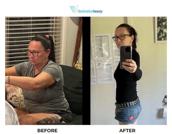 Tracey W weight loss surgery 5