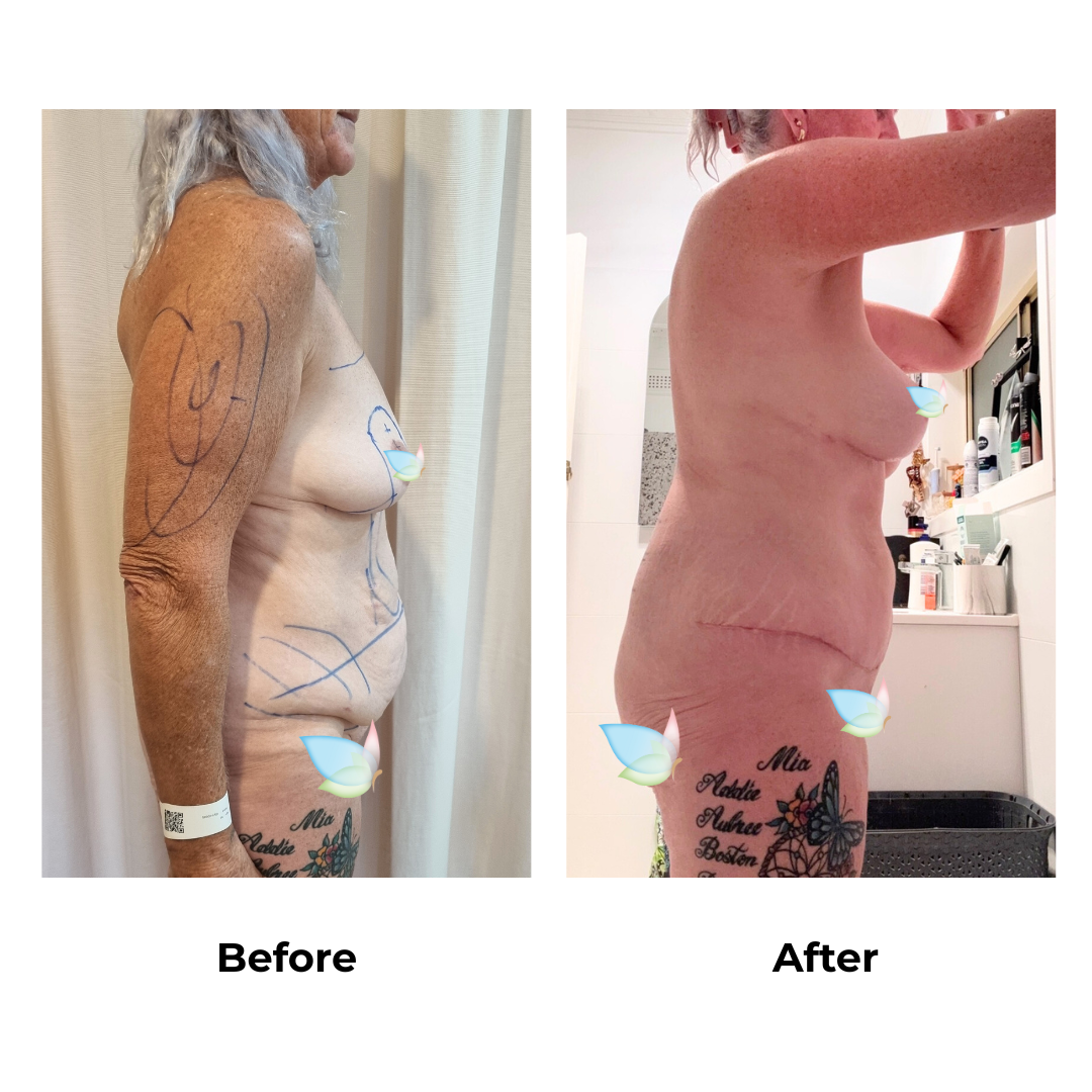 Tracey had BABL + AL + Lipo arm + Ex TT + Mon lift + Lipo with Dr. Kasemsak (1)