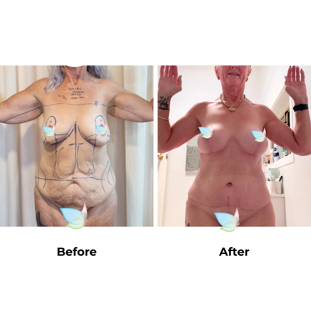Tracey had BABL + AL + Lipo arm + Ex TT + Mon lift + Lipo with Dr. Kasemsak