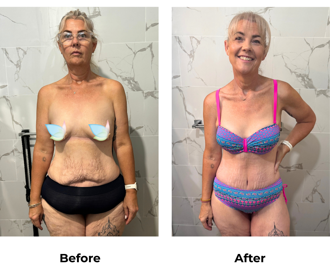 Tracey had Circum TT + Mons lift + Lipo on Lower Back + BABL with Dr. Weerachai  (1)