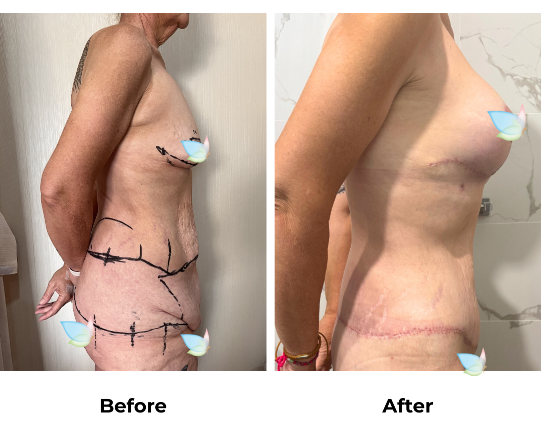 Tracey had Circum TT + Mons lift + Lipo on Lower Back + BABL with Dr. Weerachai (2)
