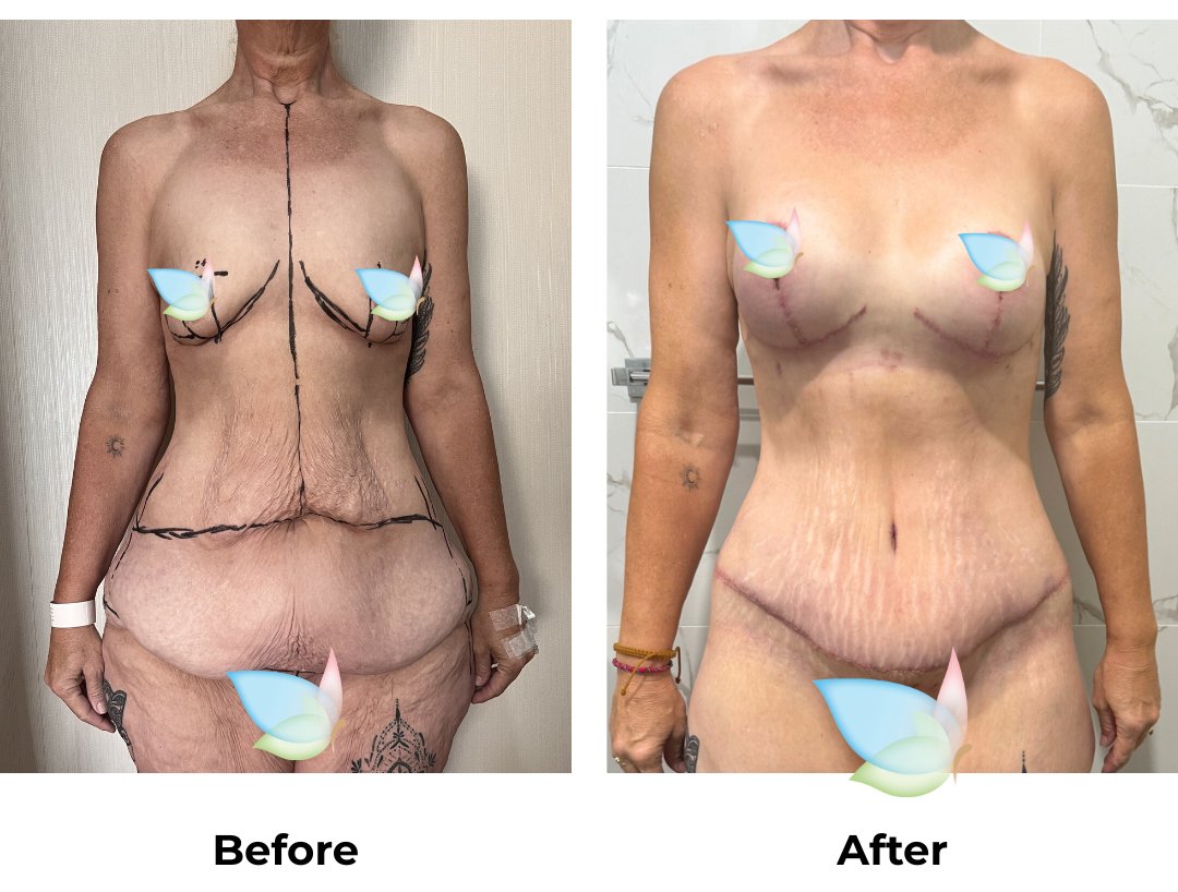 Tracey had Circum TT + Mons lift + Lipo on Lower Back + BABL with Dr. Weerachai