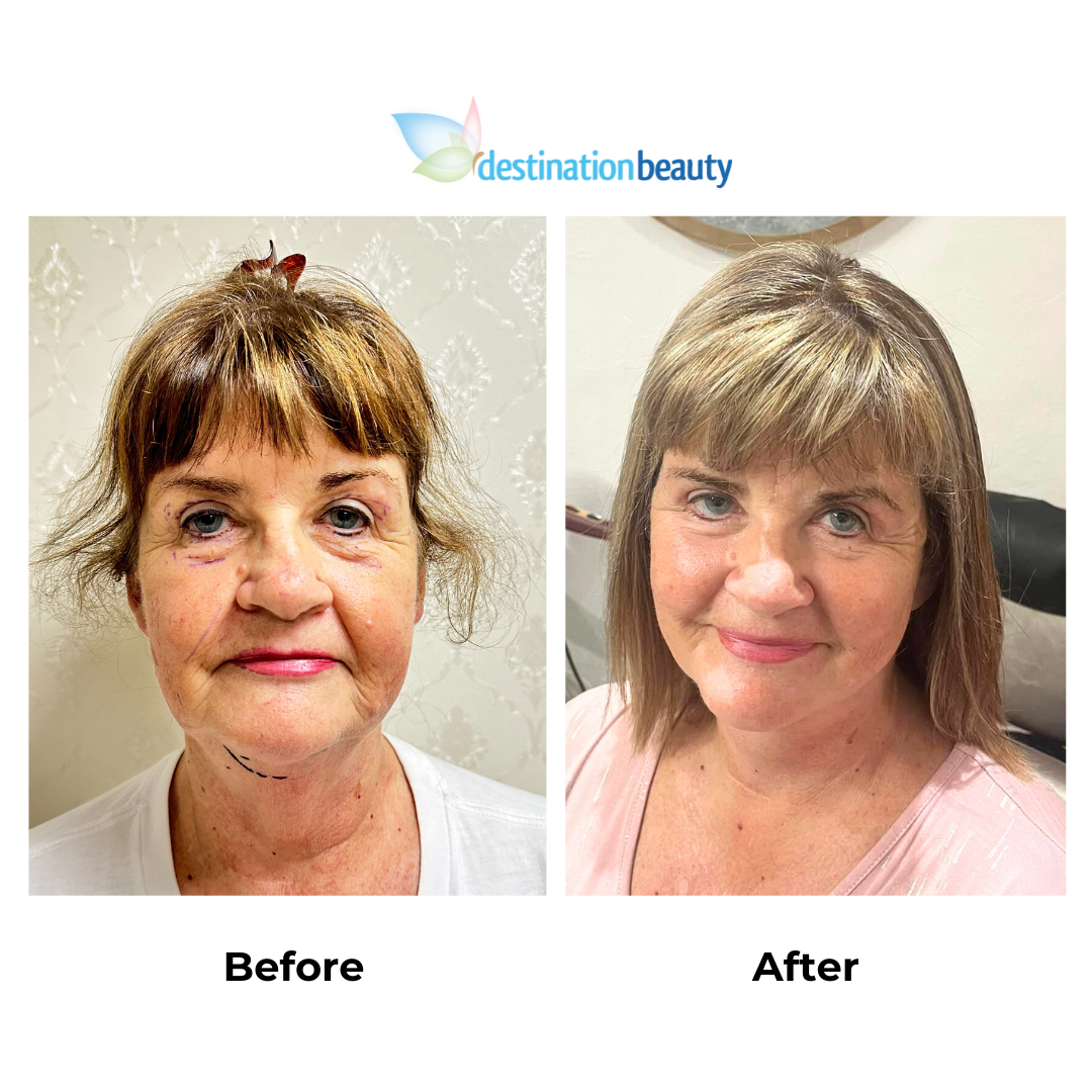 Tracey had facelift surgery with Dr. Ring 2