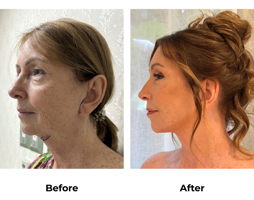 Tracy had FFNL + UB + Endoscopic Brow Lift + Chin Lift with Dr. Ring (1)