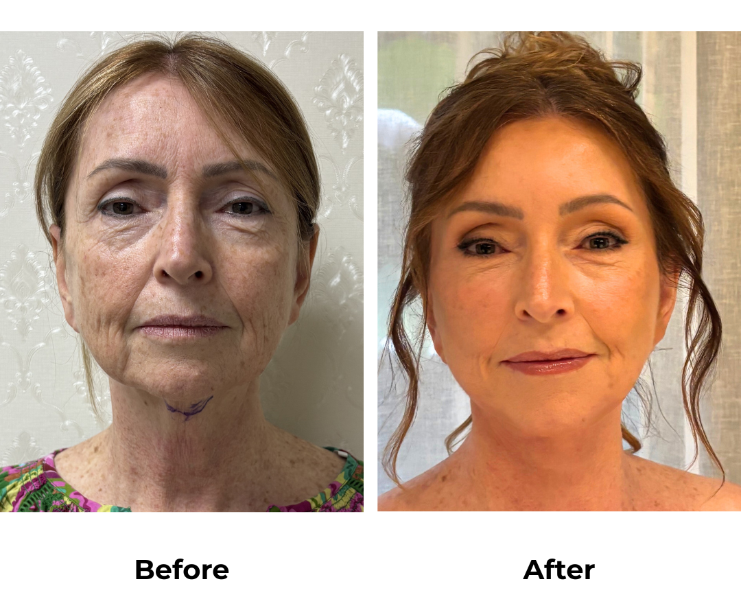 Tracy had FFNL + UB + Endoscopic Brow Lift + Chin Lift with Dr. Ring