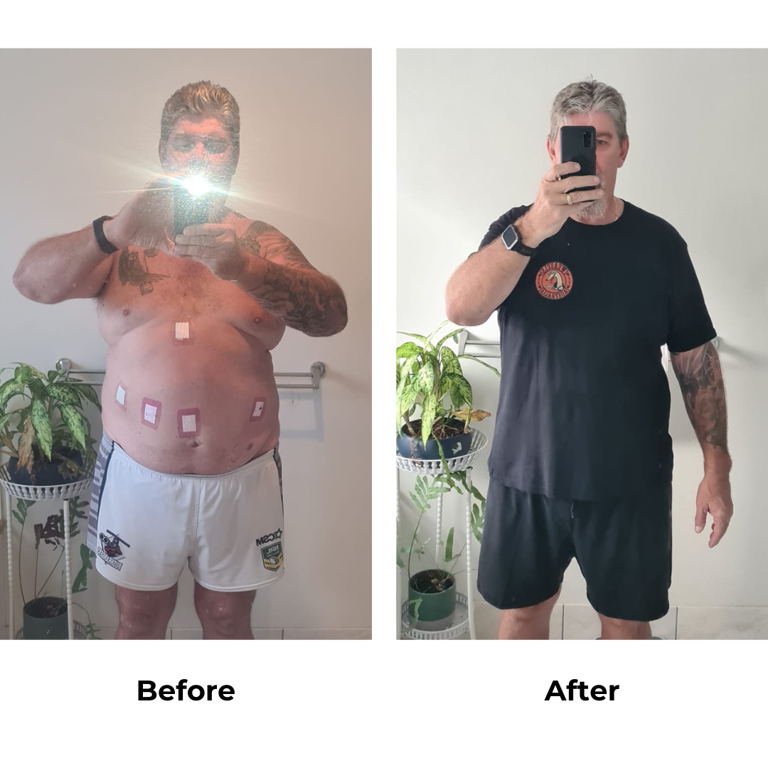 Trevor had gastric sleeve surgery (2)