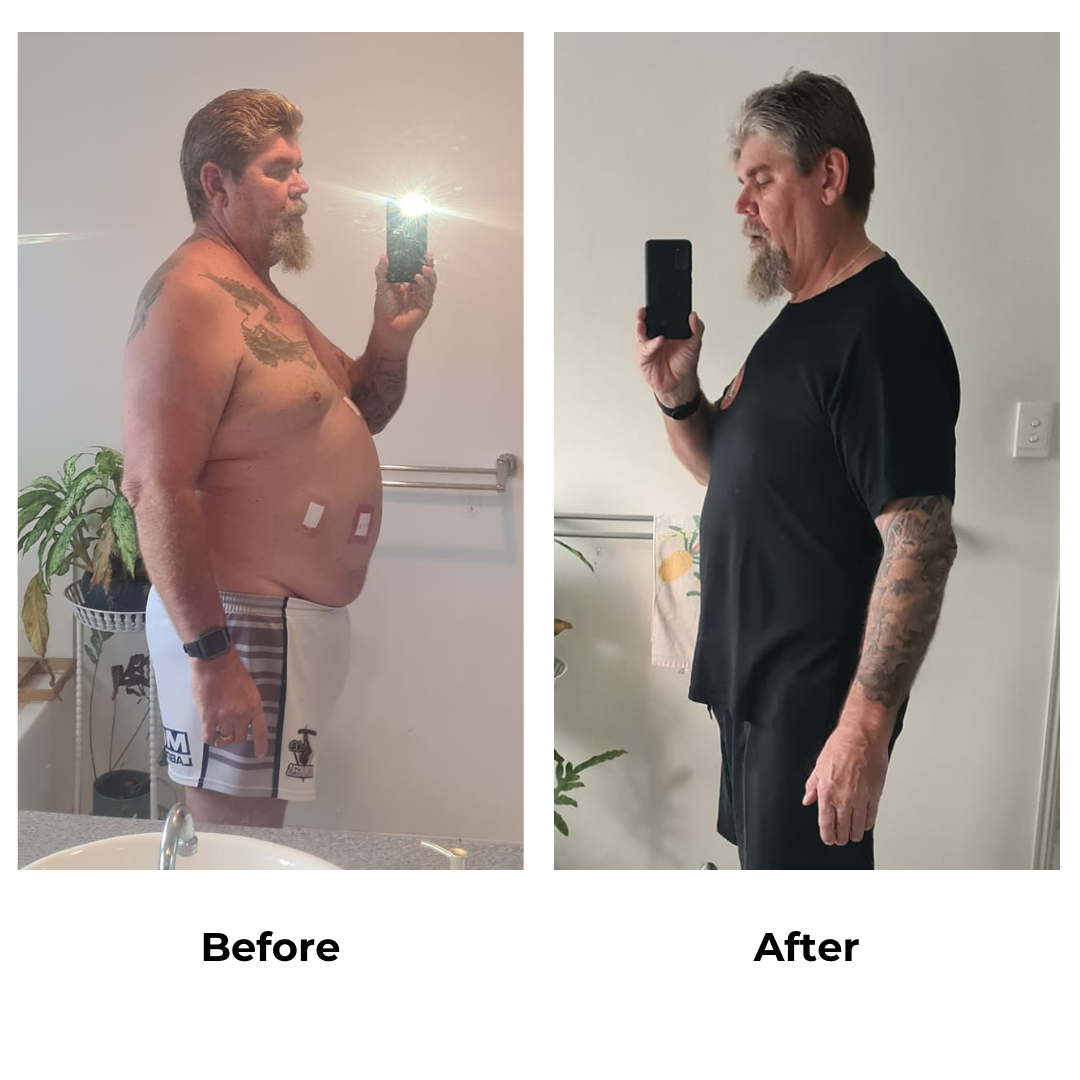 Trevor had gastric sleeve surgery