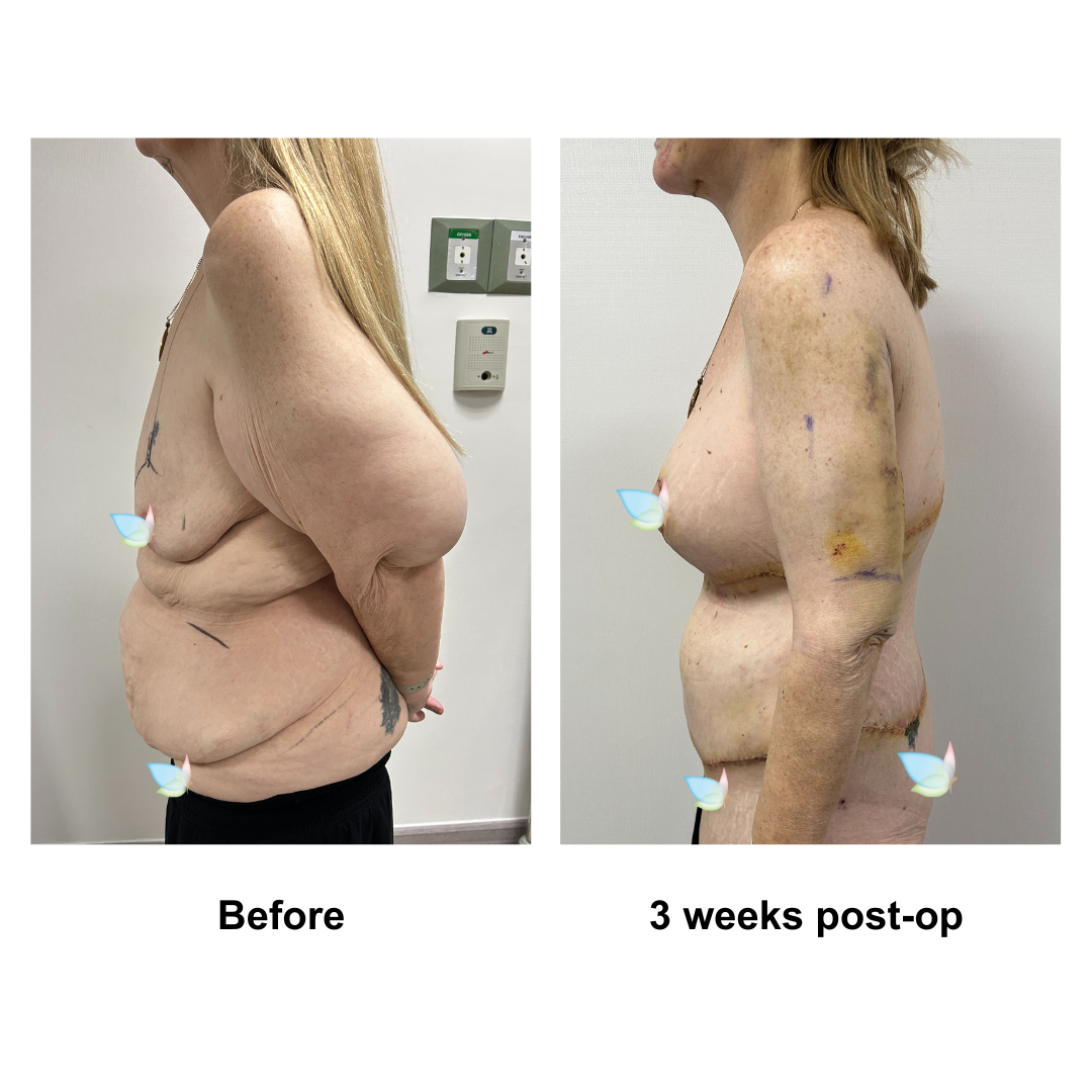Twylla had CircumTT + Upper Back lift + VASER lipo on upper abs + Mons Lift + BABL (300 HP) + AL + Lipo on upper arms with Dr. Ring (2)