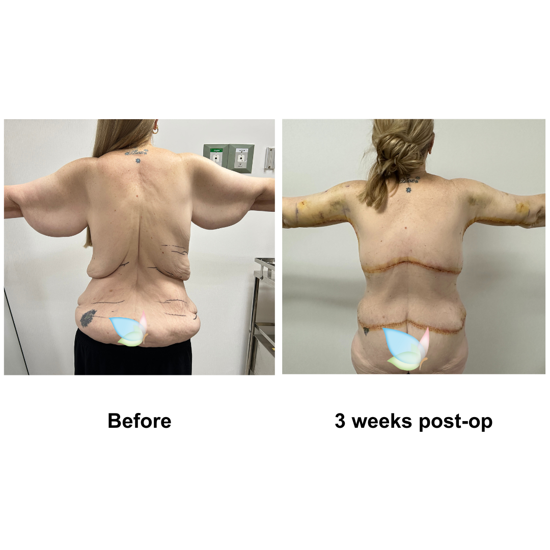 Twylla had CircumTT + Upper Back lift + VASER lipo on upper abs + Mons Lift + BABL (300 HP) + AL + Lipo on upper arms with Dr. Ring (3)