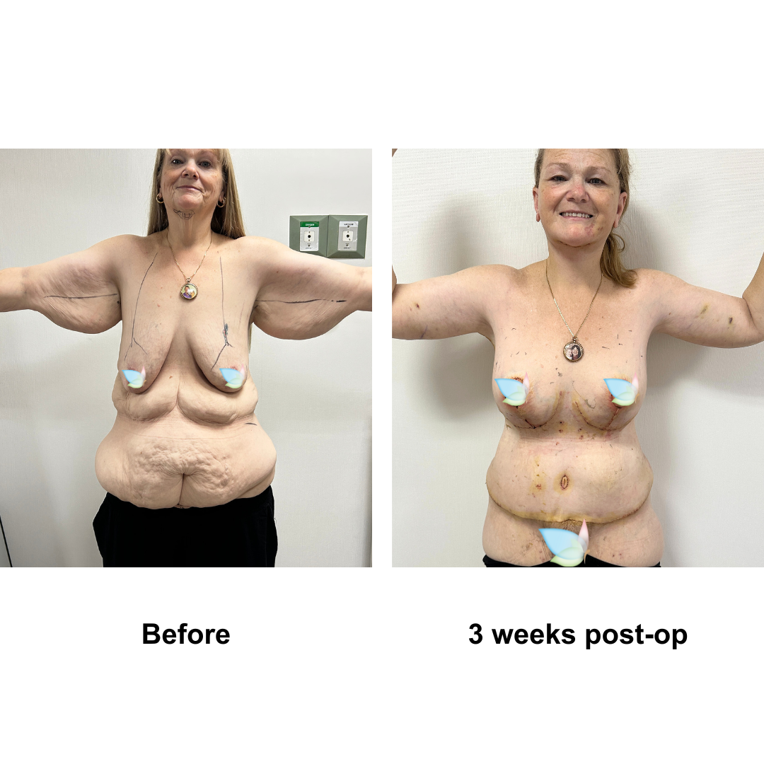 Twylla had CircumTT + Upper Back lift + VASER lipo on upper abs + Mons Lift + BABL (300 HP) + AL + Lipo on upper arms with Dr. Ring