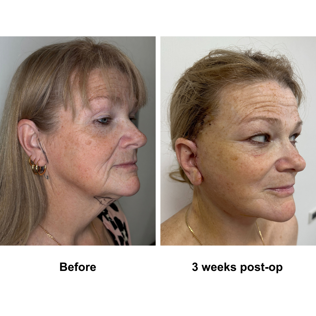 Twylla had MFNL + Chin lift with Dr. Ring (1)
