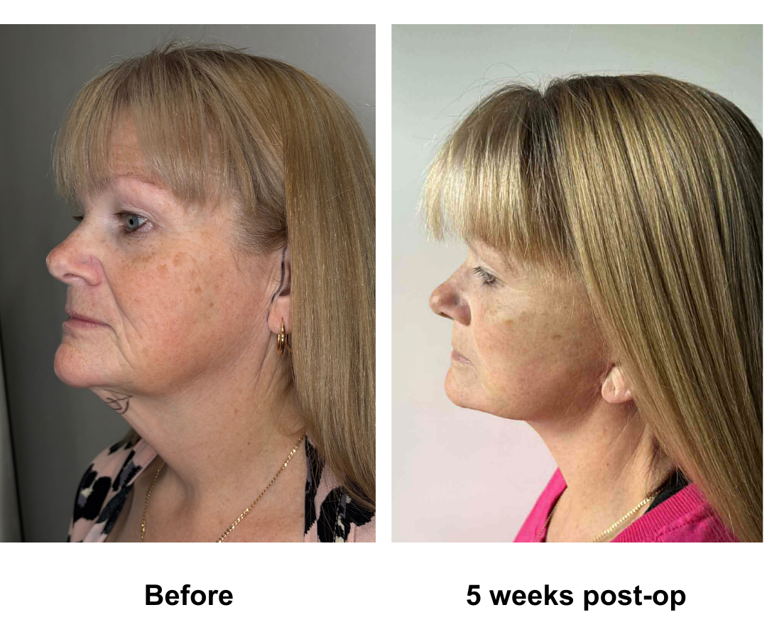 Twylla had MFNL + Chin lift with Dr. Ring-1