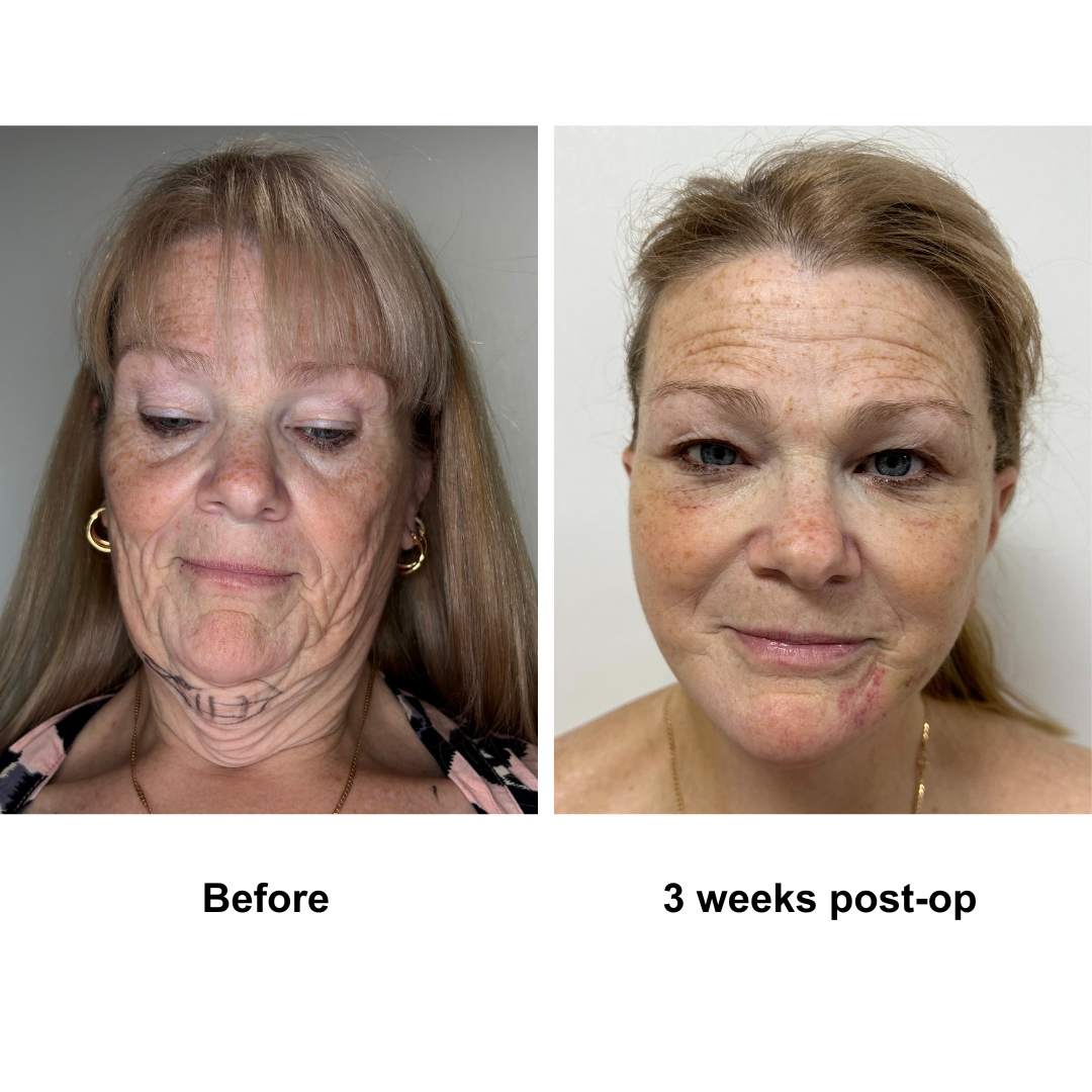 Twylla had MFNL + Chin lift with Dr. Ring