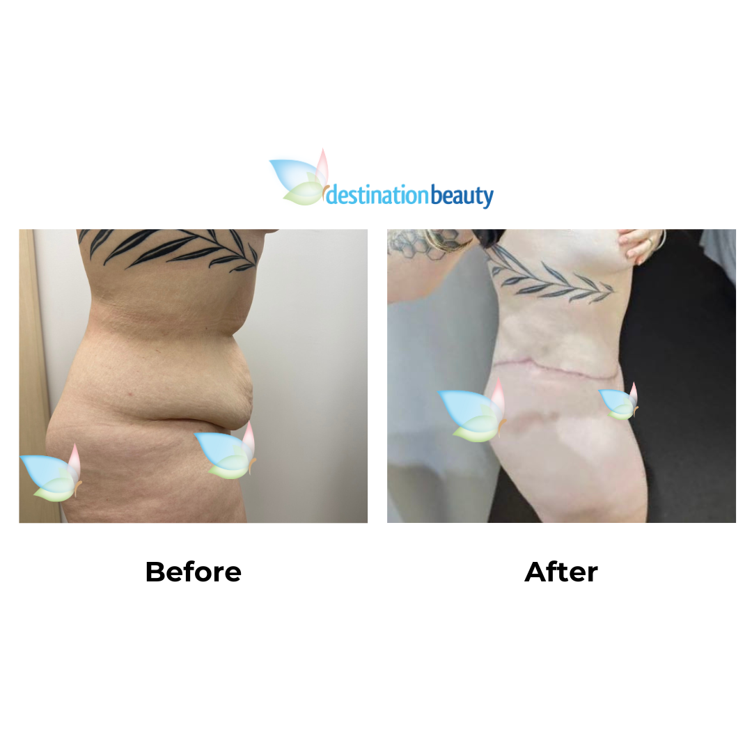 Tyras Semi circum TT + ML + Lipo with Dr. Jatuporn (2)