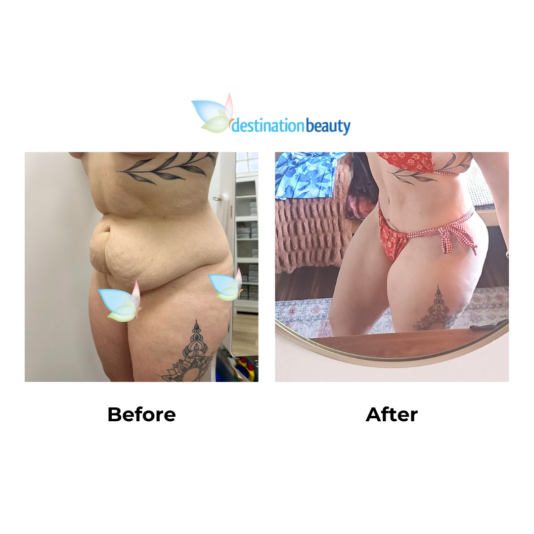 Tyras Semi circum TT + ML + Lipo with Dr. Jatuporn (3)