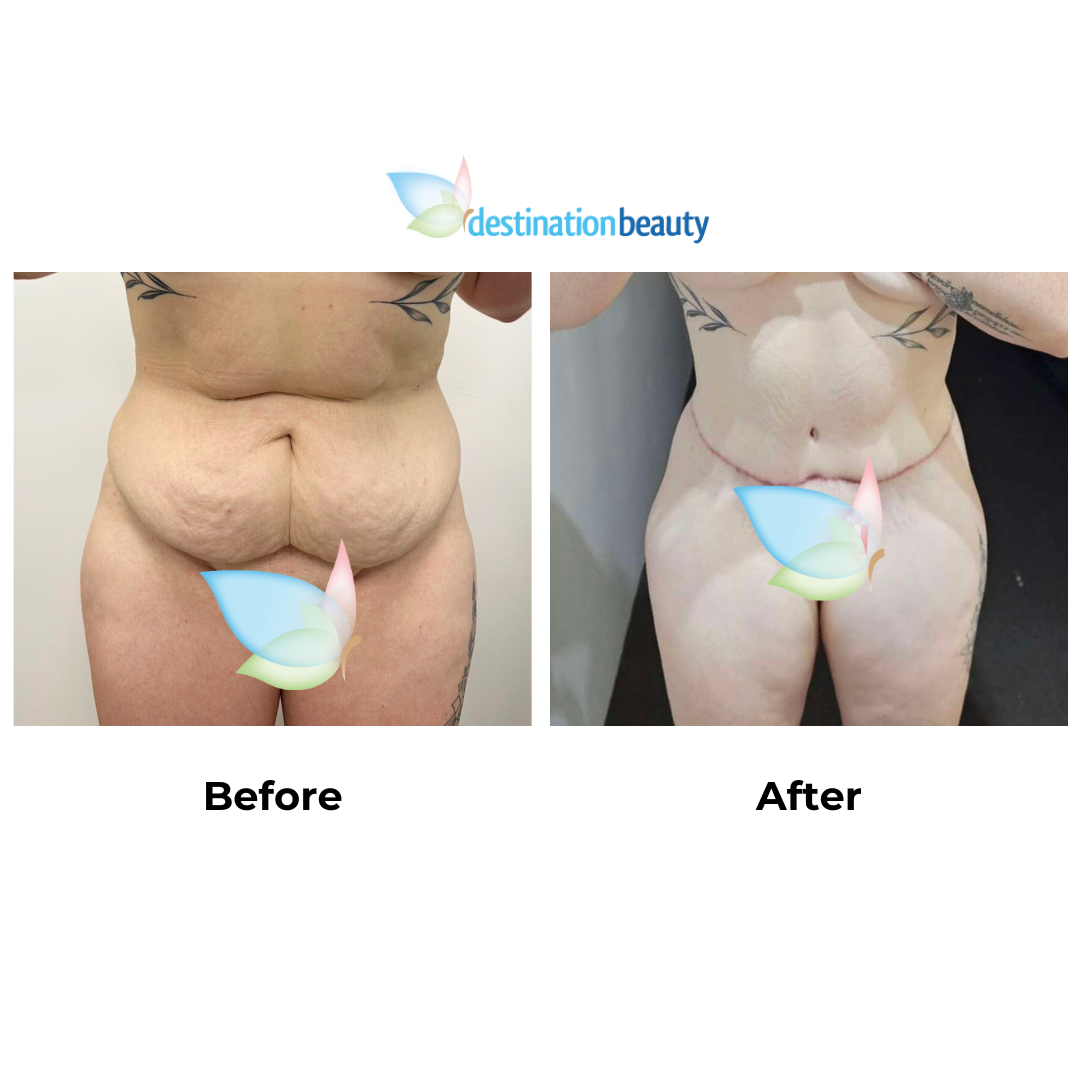 Tyras Semi circum TT + ML + Lipo with Dr. Jatuporn
