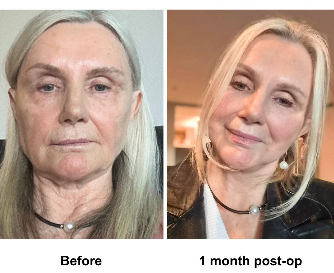 Valerie had MFNL + Chin lift with Dr. Ring (2)