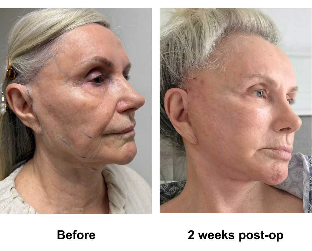 Valerie had MFNL + Chin lift with Dr. Ring (3)