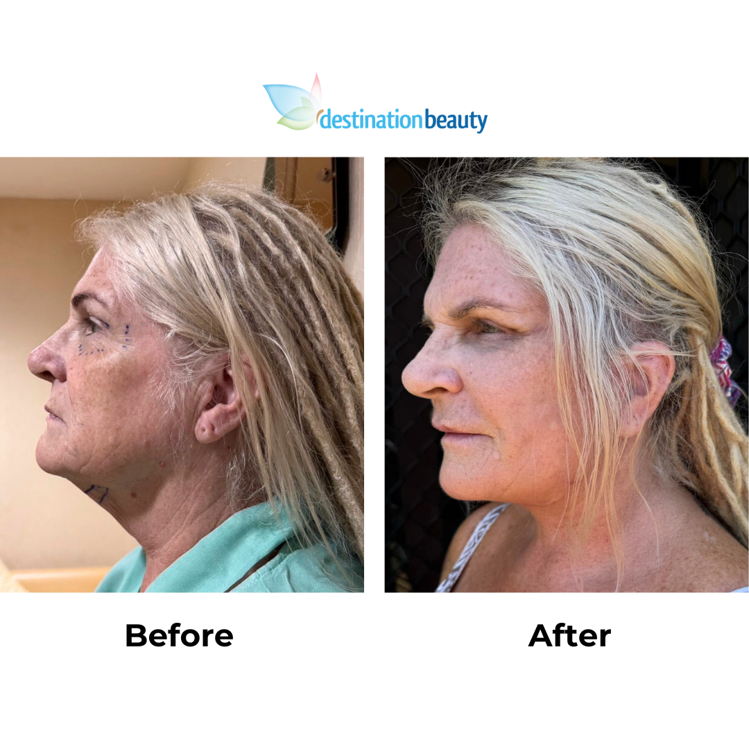 Vanessa had facelift with Dr. Ring