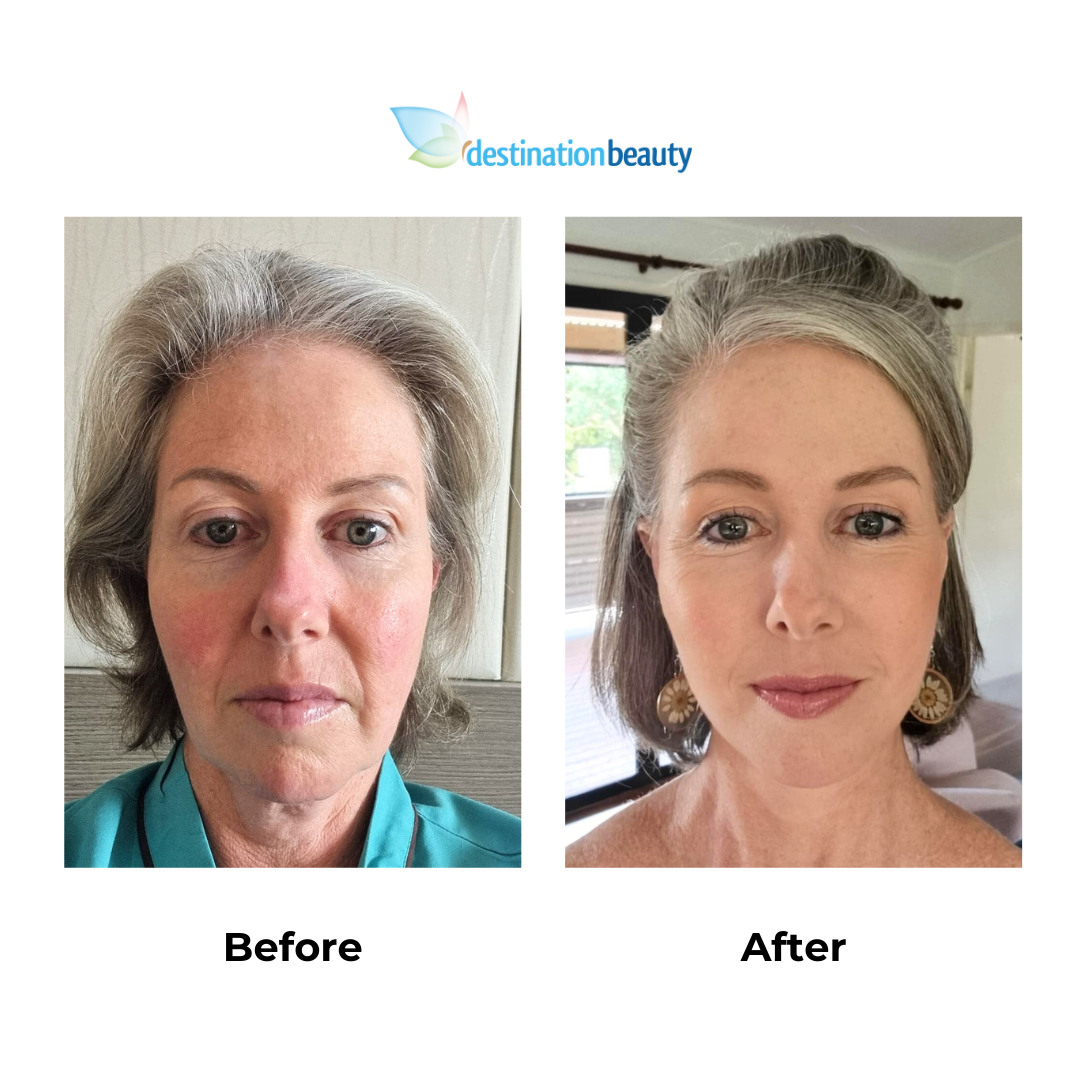 Vicky had facelift with Dr. Ring (3)