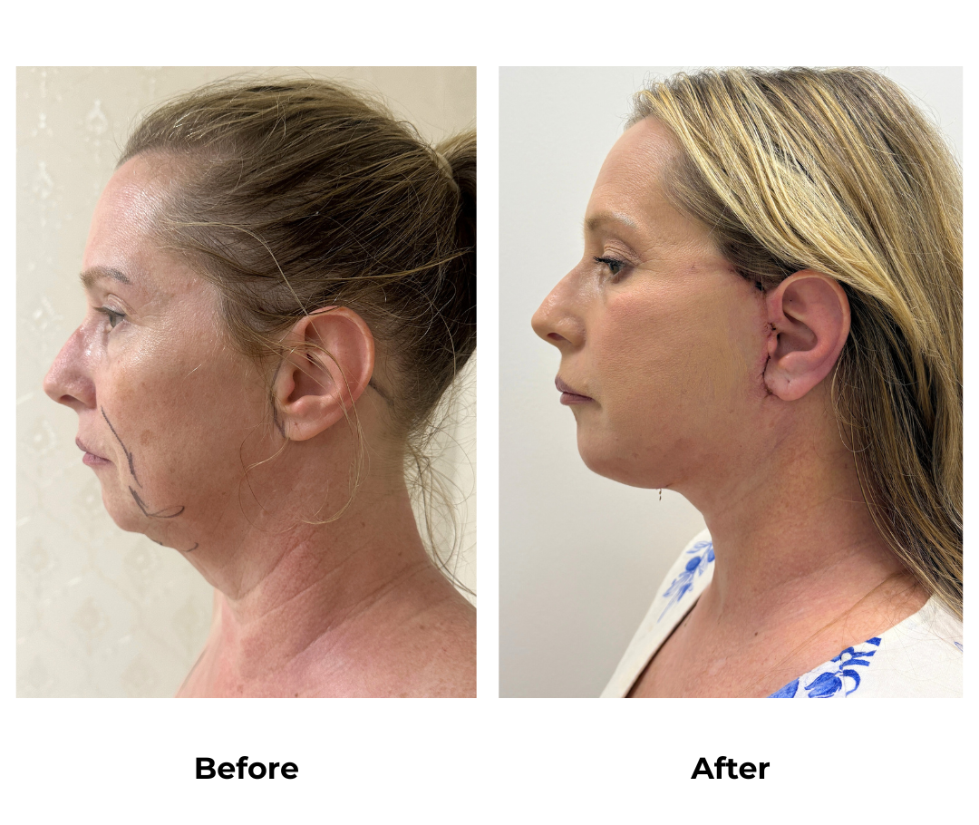 Victoria had MFNL + Chin Lift with Dr. Ring (2)