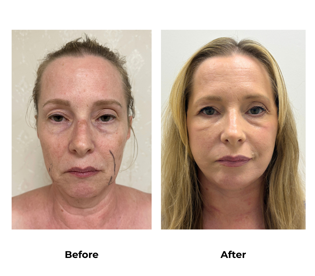 Victoria had MFNL + Chin Lift with Dr. Ring (3)