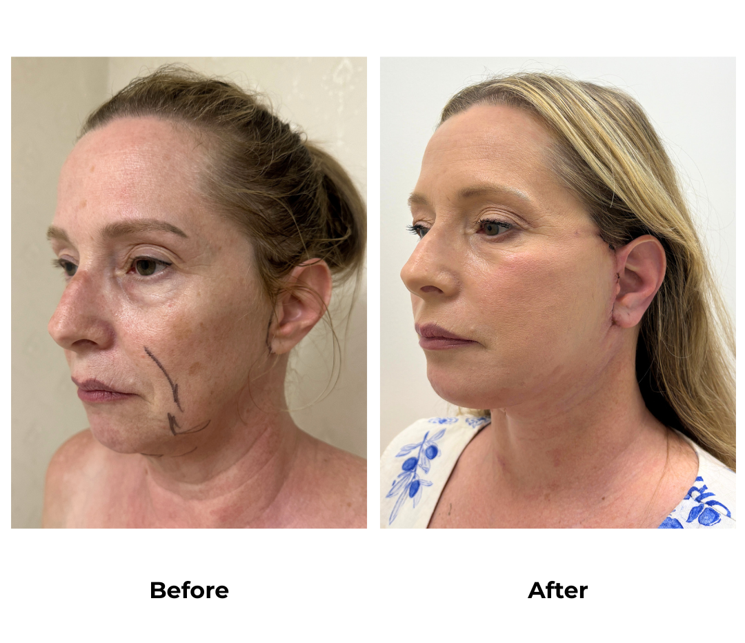 Victoria had MFNL + Chin Lift with Dr. Ring