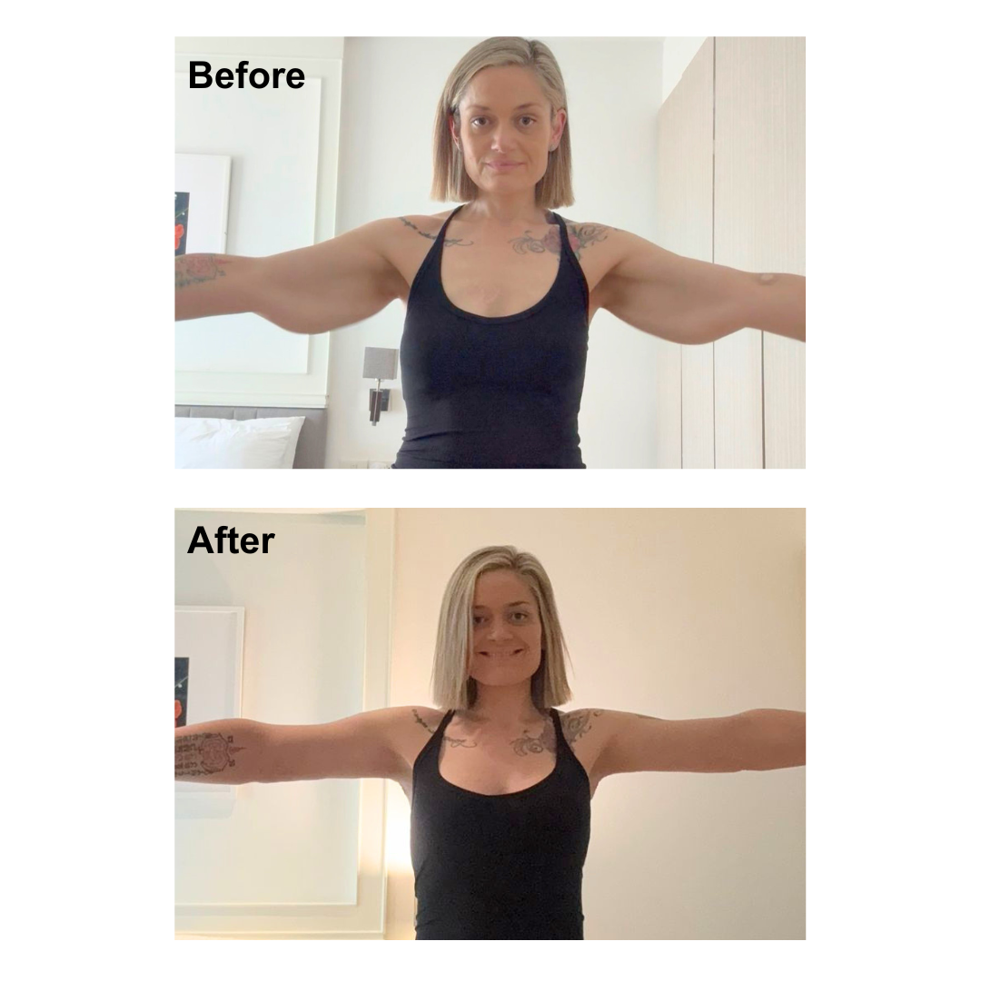 Vivien had arm lift with Dr. Kasemsak