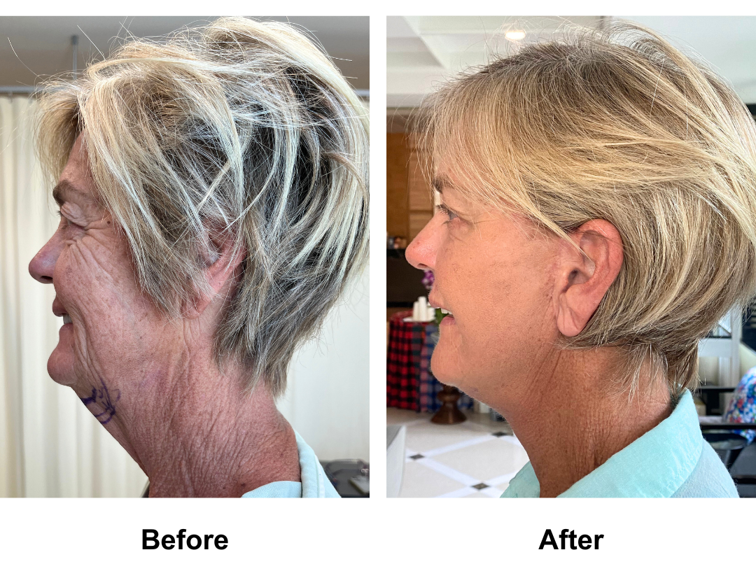 Wendy had Full Facelift, Upper & Lower Eyelids, and Chin Lift with Dr. NJ (2)