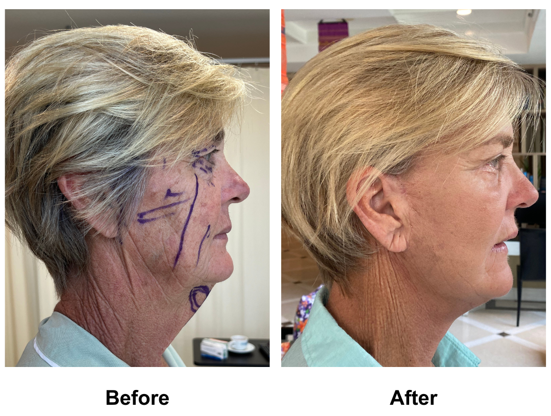 Wendy had Full Facelift, Upper & Lower Eyelids, and Chin Lift with Dr. NJ (3)