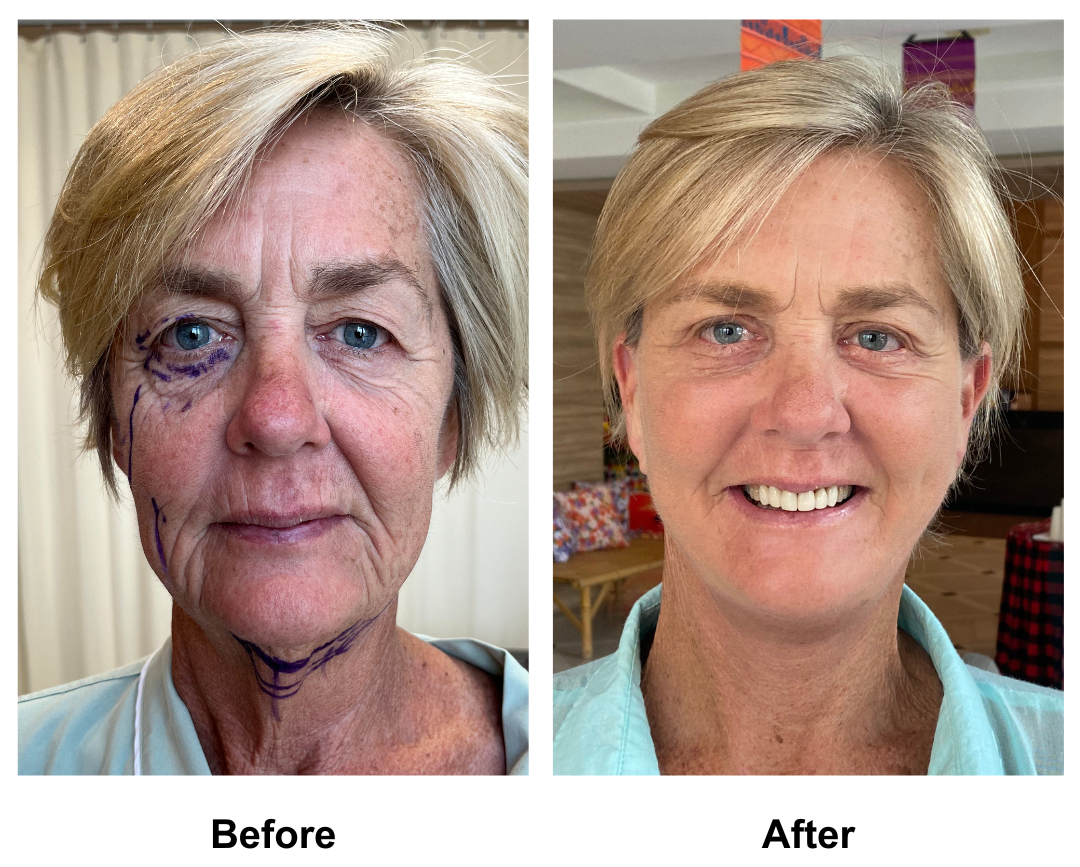Wendy had Full Facelift, Upper & Lower Eyelids, and Chin Lift with Dr. NJ