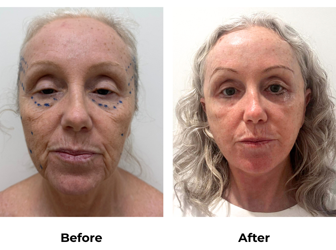 Wendy had MFNL + Chin lift + LB + EBL with Dr. Ring (1)