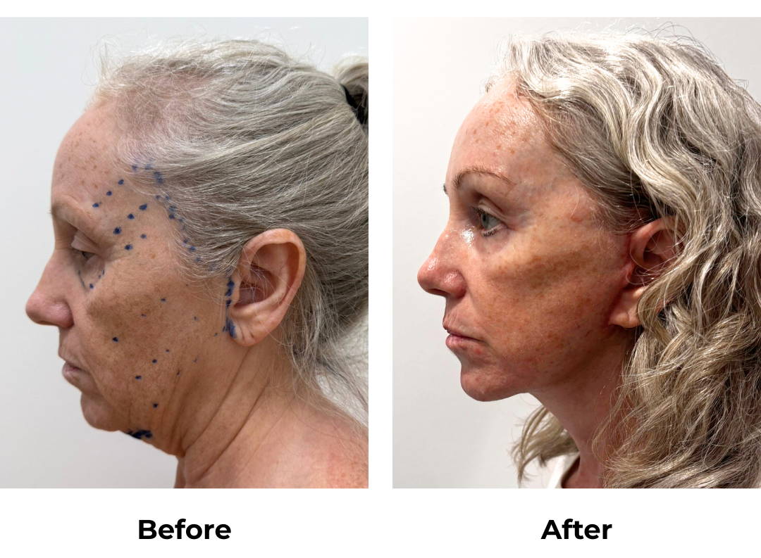 Wendy had MFNL + Chin lift + LB + EBL with Dr. Ring (3)