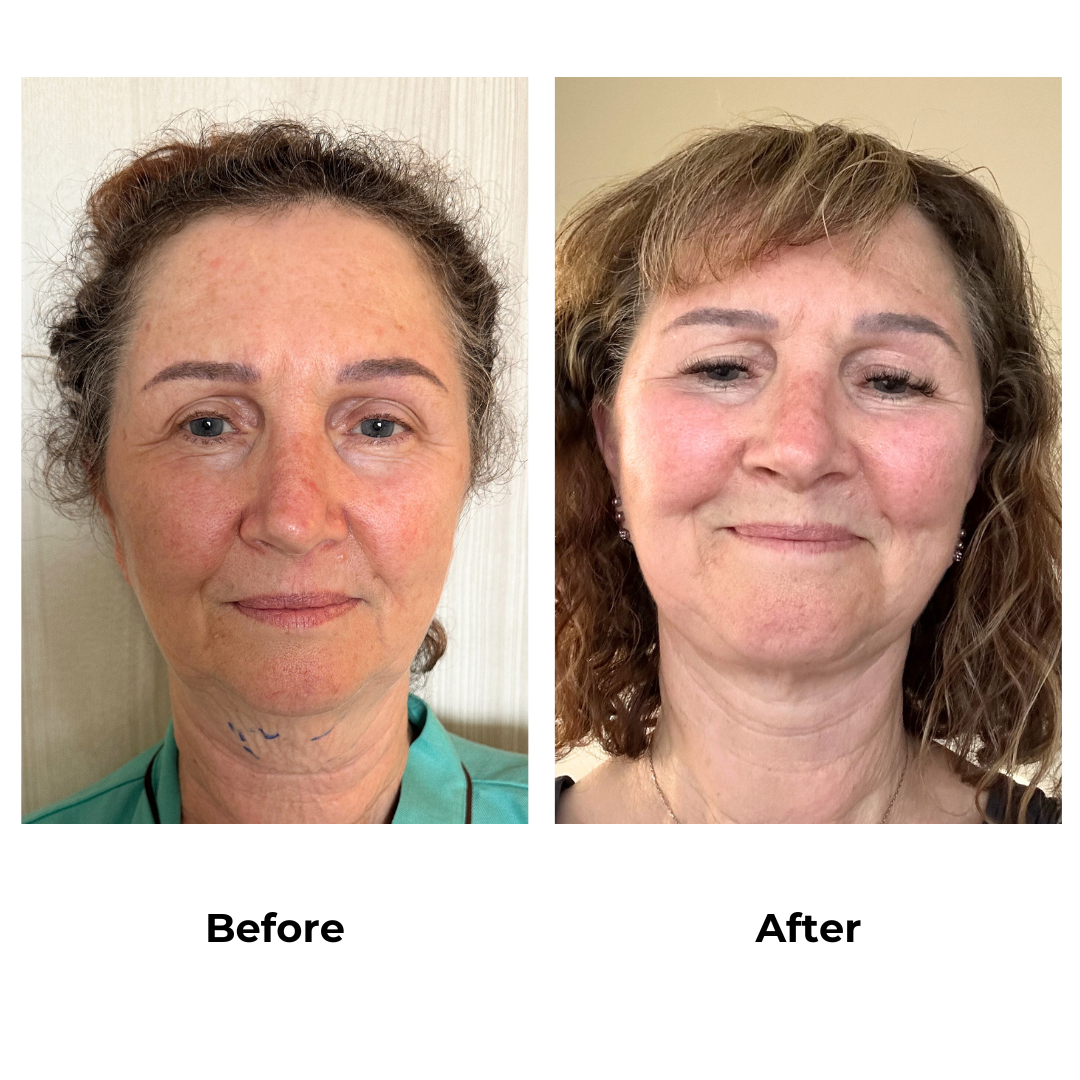 Wendy had facelift with Dr. Ring - 6 months post-op (2)