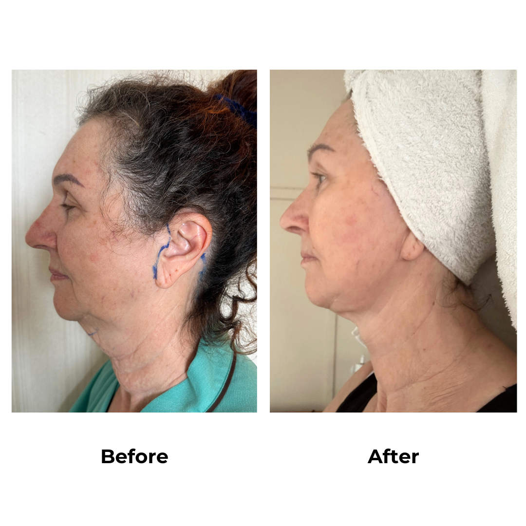 Wendy had facelift with Dr. Ring - 6 months post-op