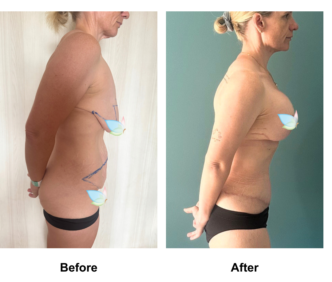 Zoe had BABL(motiva)  + ExTT + Mons lift with Dr. Weerachai (3)
