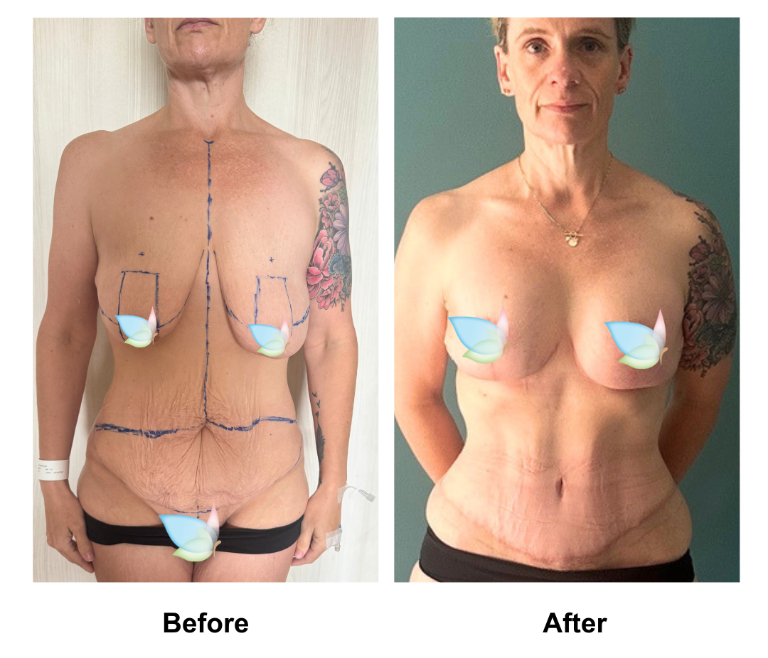 Zoe had BABL(motiva)  + ExTT + Mons lift with Dr. Weerachai (4)