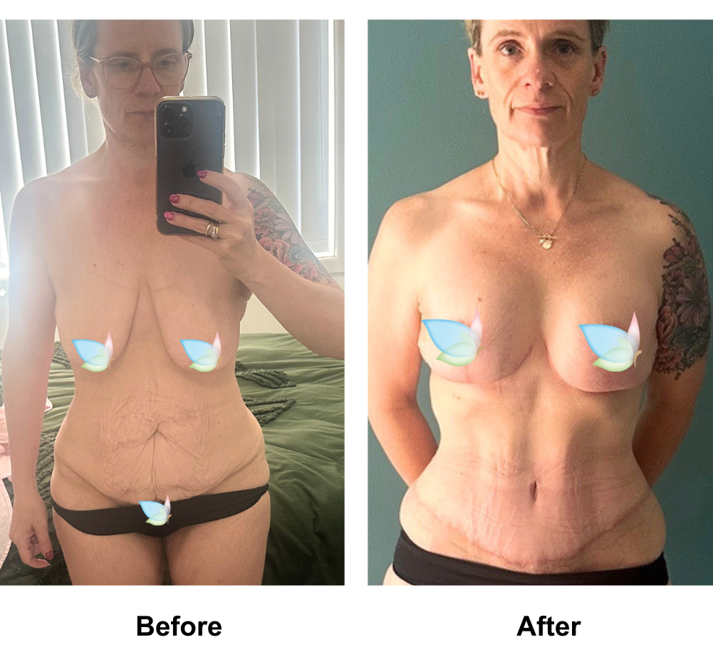 Zoe had BABL(motiva)  + ExTT + Mons lift with Dr. Weerachai (5)