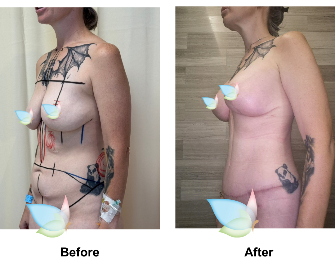 Zoe had Ex TT + Lipo x2 (upper abs and love handles) + Mons Lift + BABL with Dr. Tawan (1)-1