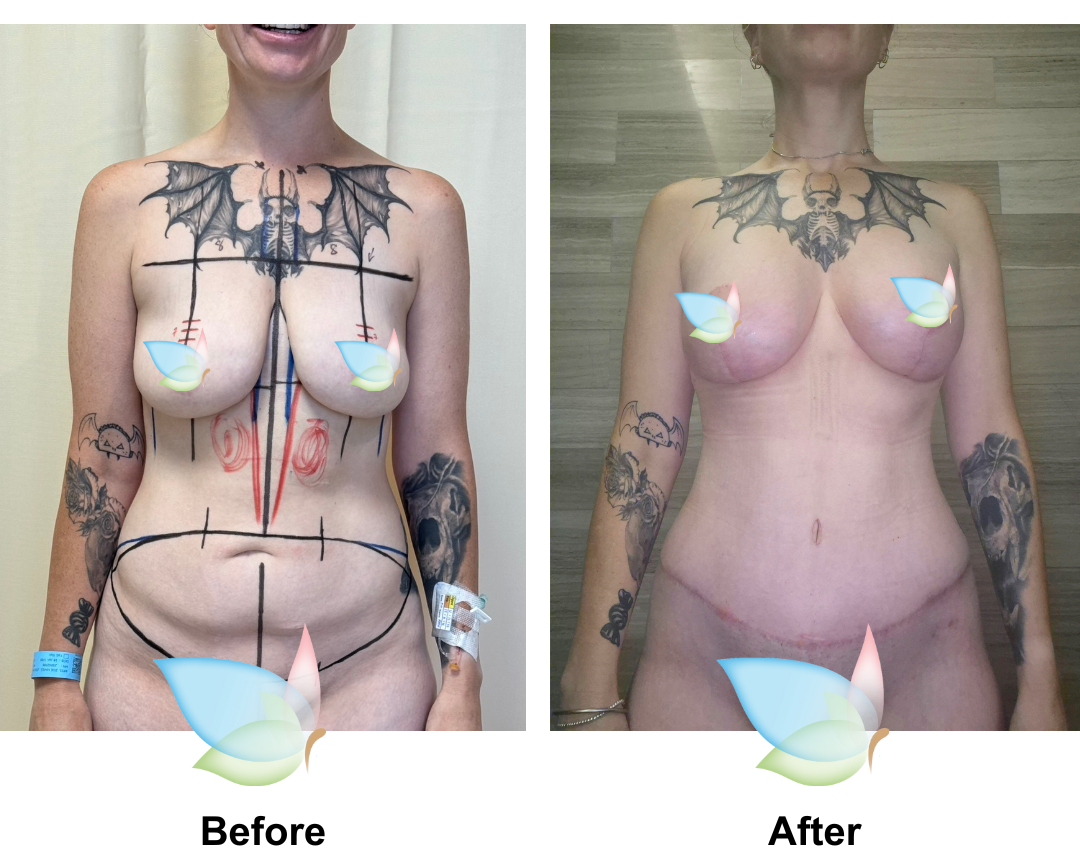 Zoe had Ex TT + Lipo x2 (upper abs and love handles) + Mons Lift + BABL with Dr. Tawan-1