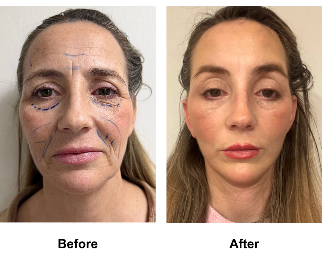 Zoe had MFNL + LB + EBL with Dr. Ring