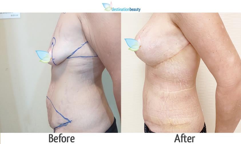 arm llift, breast lift, breast implants, extended tummy tuck, mons lift 3