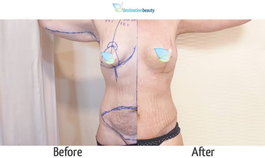 arm llift, breast lift, breast implants, extended tummy tuck, mons lift