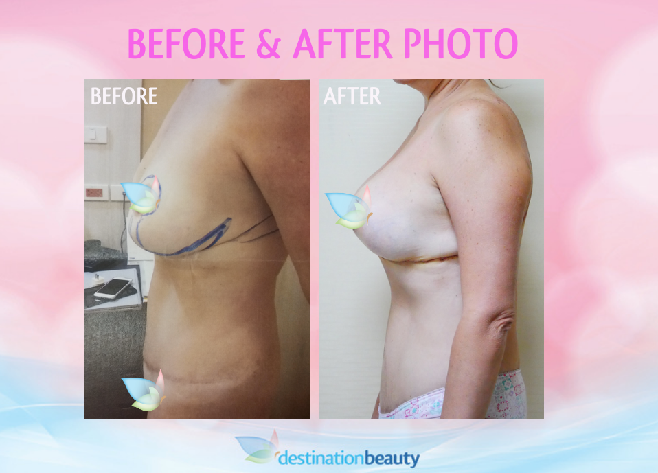 before and after breast reduction and lift with implant in Bangkok (3)